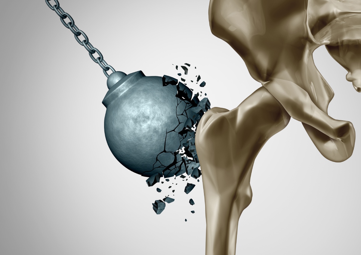Illustration of a wrecking ball smashing into a bone, causing it to fracture into small pieces.