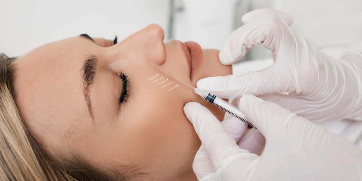 nasolabial folds filler