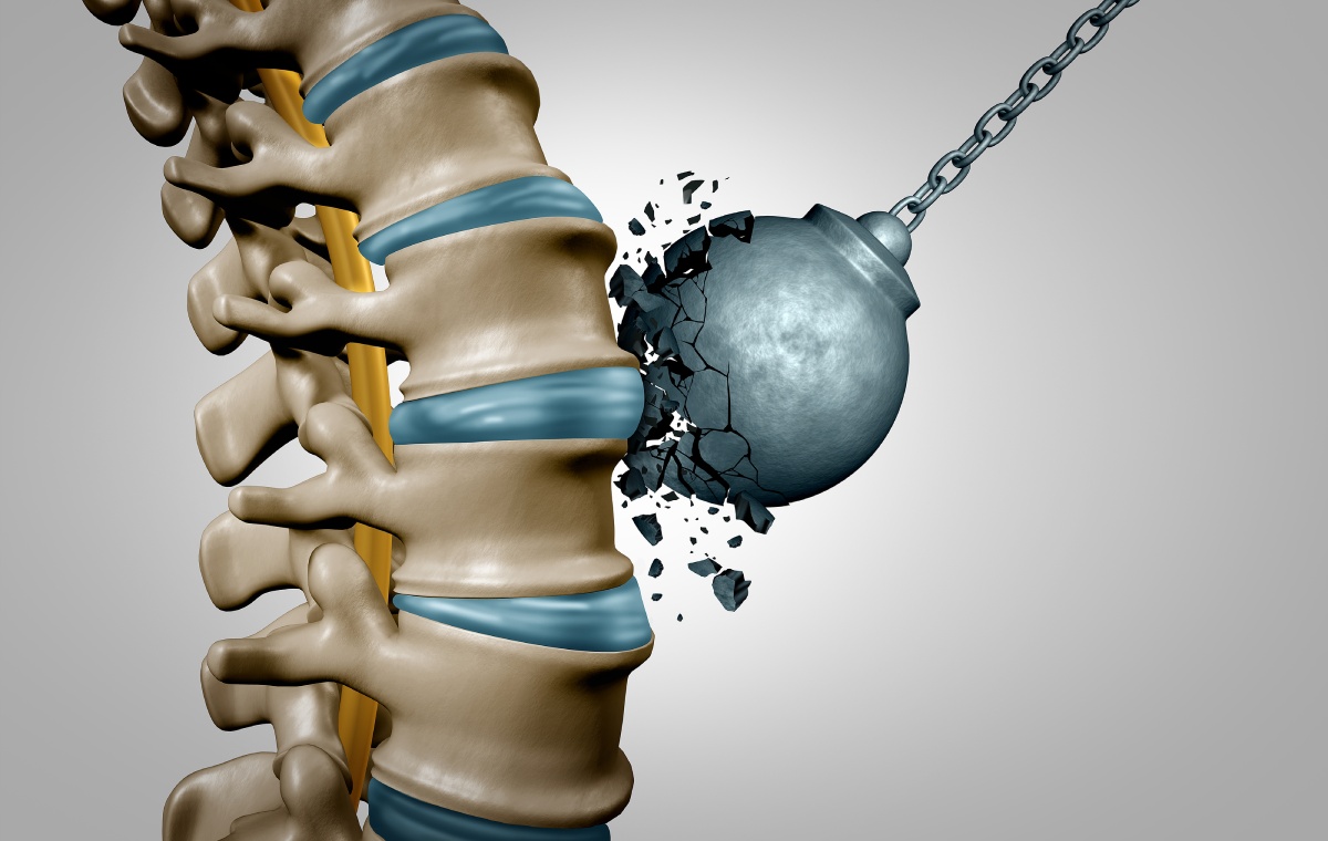 Illustration of a wrecking ball smashing through a human spine, symbolizing spinal injury or damage.